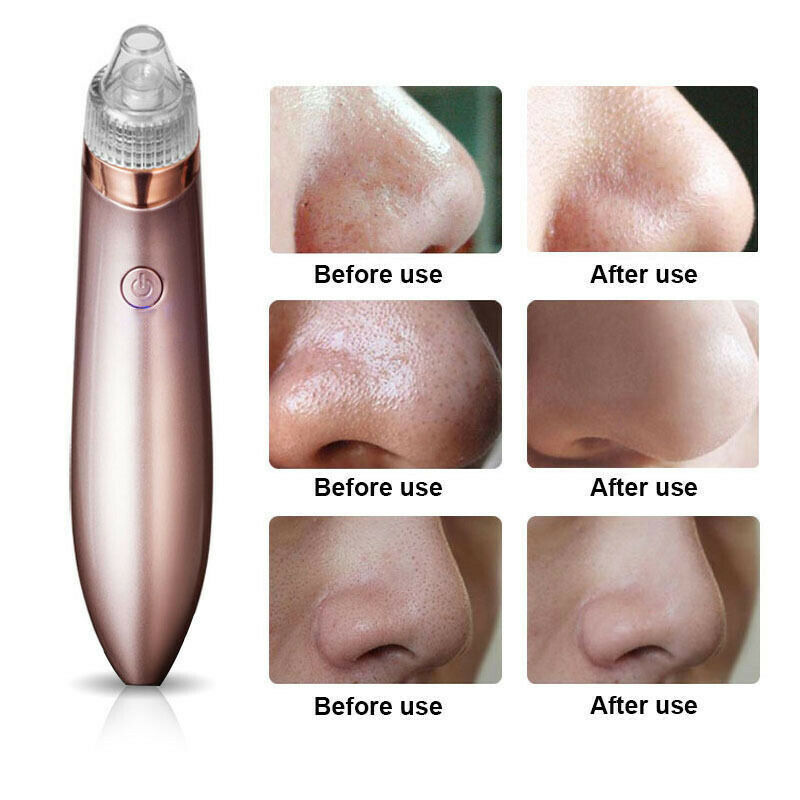 Web Based Blackhead Vacuum Pore Cleaner Acne Pimple Remover Strong Suction Tool Electric Blackhead Remover Pore Vacuum Suction Diamond Dermabrasion Face Cleaner